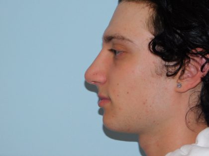 Rhinoplasty Before & After Patient #3064