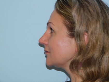 Rhinoplasty Before & After Patient #3059