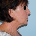 Traditional Facelift Before & After Patient #1658