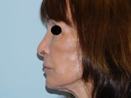 Revision Rhinoplasty Before & After Patient #1549