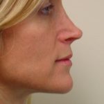 Revision Rhinoplasty Before & After Patient #1600