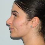 Revision Rhinoplasty Before & After Patient #1601