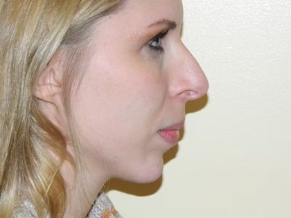 Revision Rhinoplasty Before & After Patient #1546