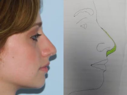 Revision Rhinoplasty Before & After Patient #1547