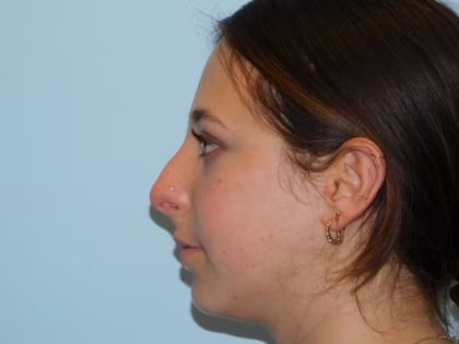 Chin Augmentation Before & After Patient #1085