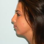 Chin Augmentation Before & After Patient #1218