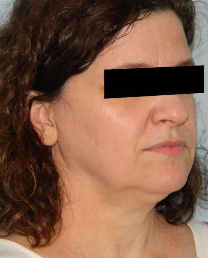 Neck Submental Liposuction Before & After Patient #957
