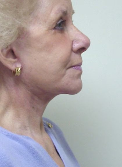 Traditional Facelift Before & After Patient #1690