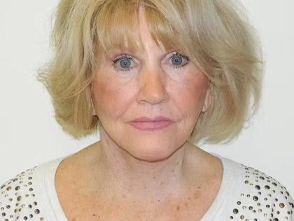 Traditional Facelift Before & After Patient #1722