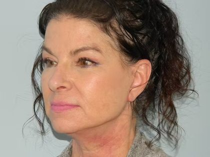 Traditional Facelift Before & After Patient #1747