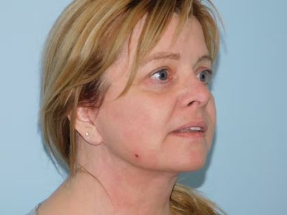 Traditional Facelift Before & After Patient #1752