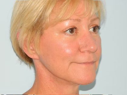 Traditional Facelift Before & After Patient #1656