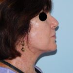 Traditional Facelift Before & After Patient #1658