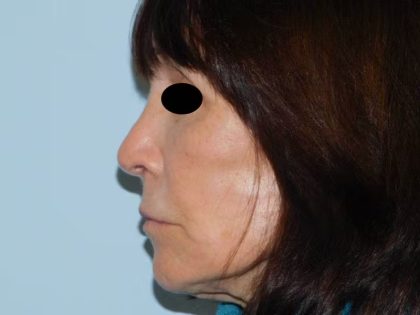 Revision Rhinoplasty Before & After Patient #1549