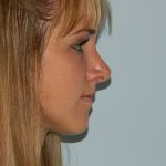 Revision Rhinoplasty Before & After Patient #1596