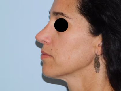 Revision Rhinoplasty Before & After Patient #1597
