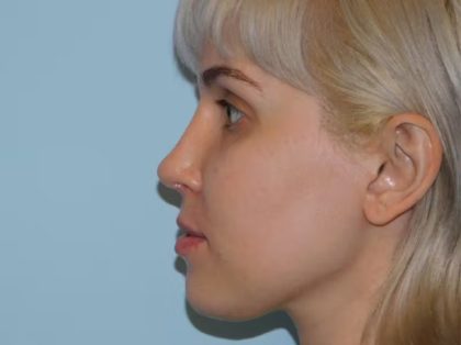 Revision Rhinoplasty Before & After Patient #1599