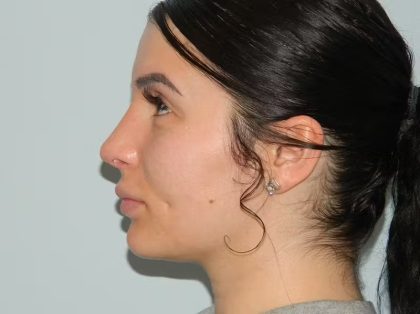 Revision Rhinoplasty Before & After Patient #1601