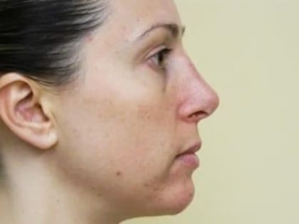Revision Rhinoplasty Before & After Patient #1517