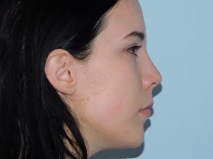 Chin Augmentation Before & After Patient #1038