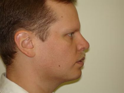 Chin Augmentation Before & After Patient #1118