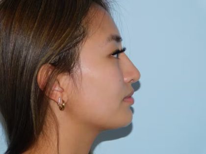 Chin Augmentation Before & After Patient #1120