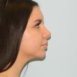 Chin Augmentation Before & After Patient #1207