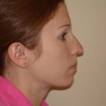 Chin Augmentation Before & After Patient #1083