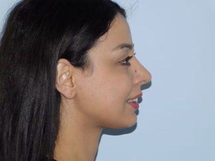 Neck Submental Liposuction Before & After Patient #958