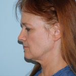 Traditional Facelift Before & After Patient #1750