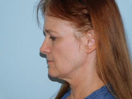 Traditional Facelift Before & After Patient #1750