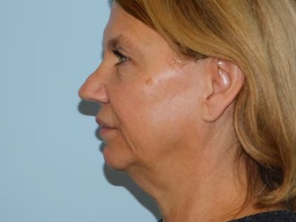 Traditional Facelift Before & After Patient #1814