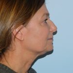 Traditional Facelift Before & After Patient #1815