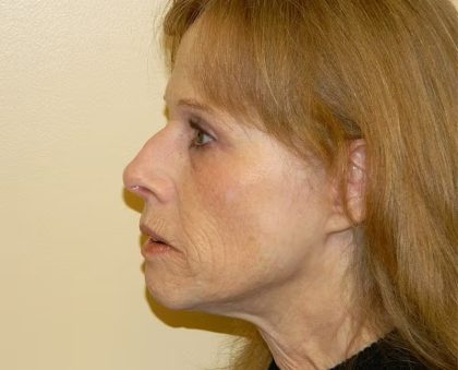 Fraxel Laser Resurfacing Before & After Patient #1494