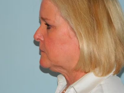 Traditional Facelift Before & After Patient #1686