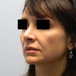 Revision Rhinoplasty Before & After Patient #1515