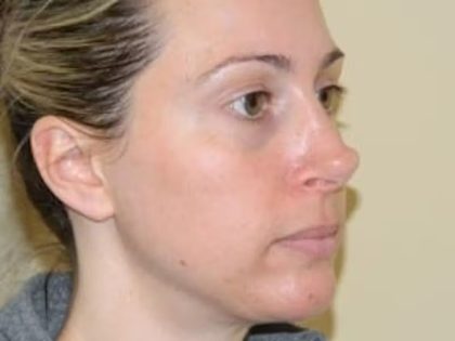 Revision Rhinoplasty Before & After Patient #1517