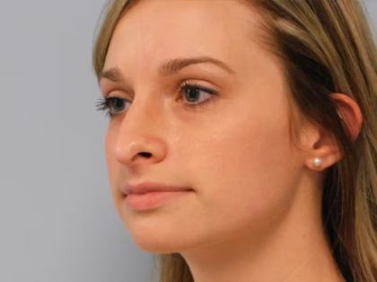Revision Rhinoplasty Before & After Patient #1547