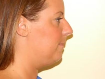 Chin Augmentation Before & After Patient #1119