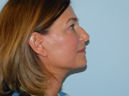 Traditional Facelift Before & After Patient #1815