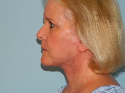 Traditional Facelift Before & After Patient #1686