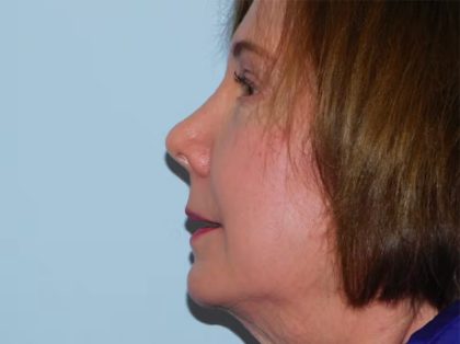 Revision Rhinoplasty Before & After Patient #1544