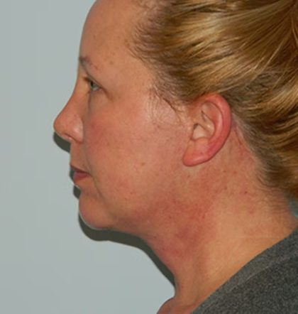 Traditional Facelift Before & After Patient #1655