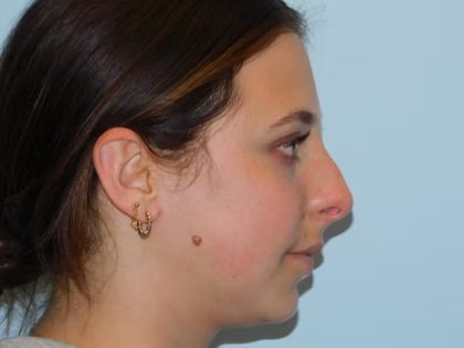 Chin Augmentation Before & After Patient #1085