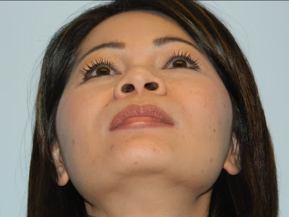 Rhinoplasty Before & After Patient #2875