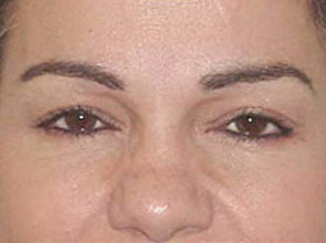 Botox Before & After Patient #1165