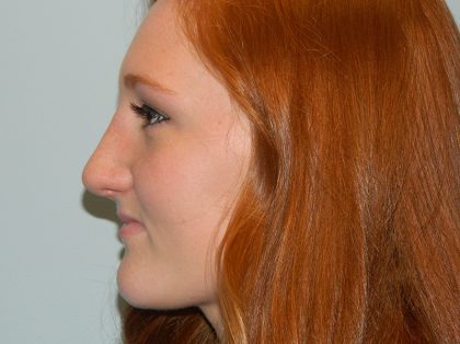 Rhinoplasty Before & After Patient #3068