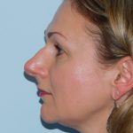 Rhinoplasty Before & After Patient #3059