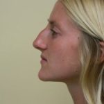 Rhinoplasty Before & After Patient #2676