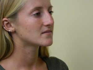 Rhinoplasty Before & After Patient #2676
